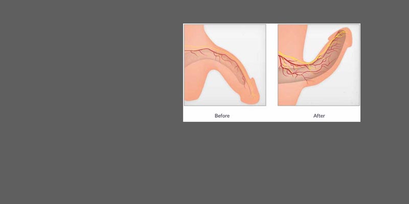 Erectile Dysfunction Treatment in Dubai