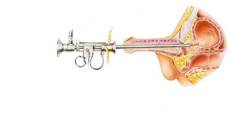 Prostate Treatment in Dubai 
